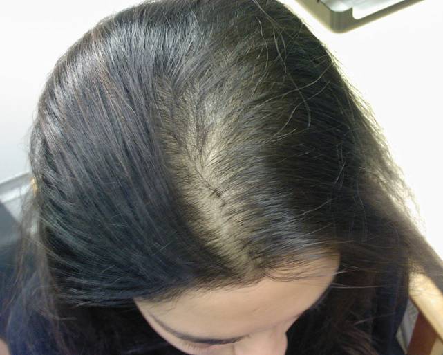 The Condition Named Alopecia Areata