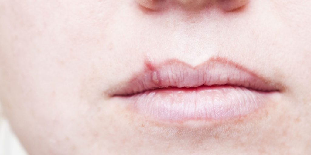 Cold Sore Free Forever Review