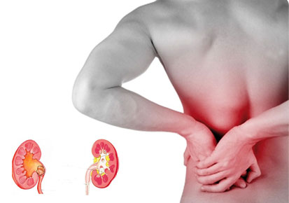Knowing The Signs Of Kidney Stones